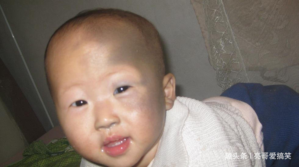 宝宝身上有胎记是怎么回事,孕期要注意