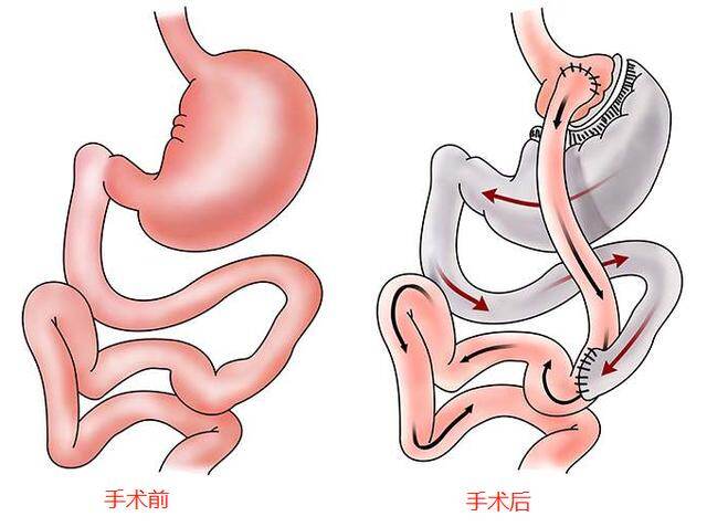 手术可以治愈糖尿病？还真不是骗局！但是你需要知道这些真相