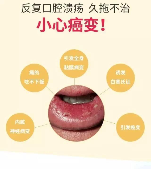 医生告诉您:这样预防和治疗口腔溃疡