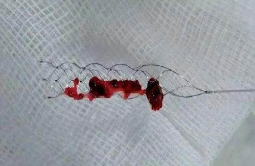 人都脑梗了！医生只是拍片子，输液！为啥不抢救？实情原来如此