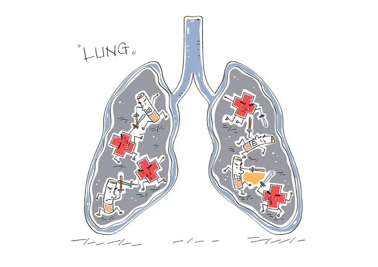 肺部常见的疾病有这几种，千万不要忽视