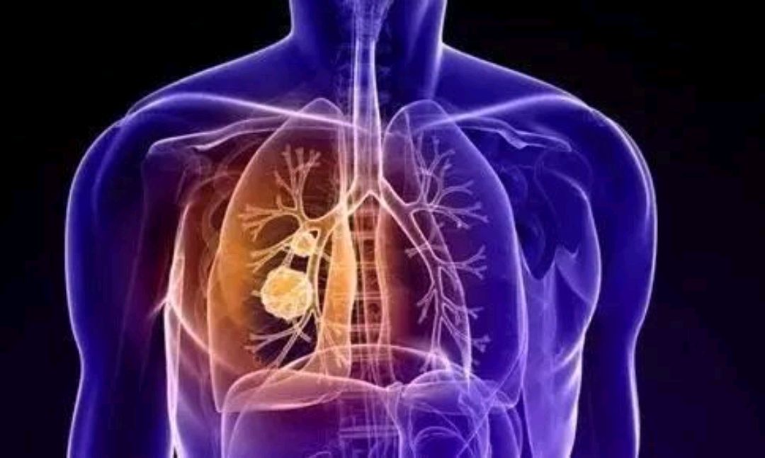 肺部出现结节身体通常有4个表现5类人要当心别不听劝
