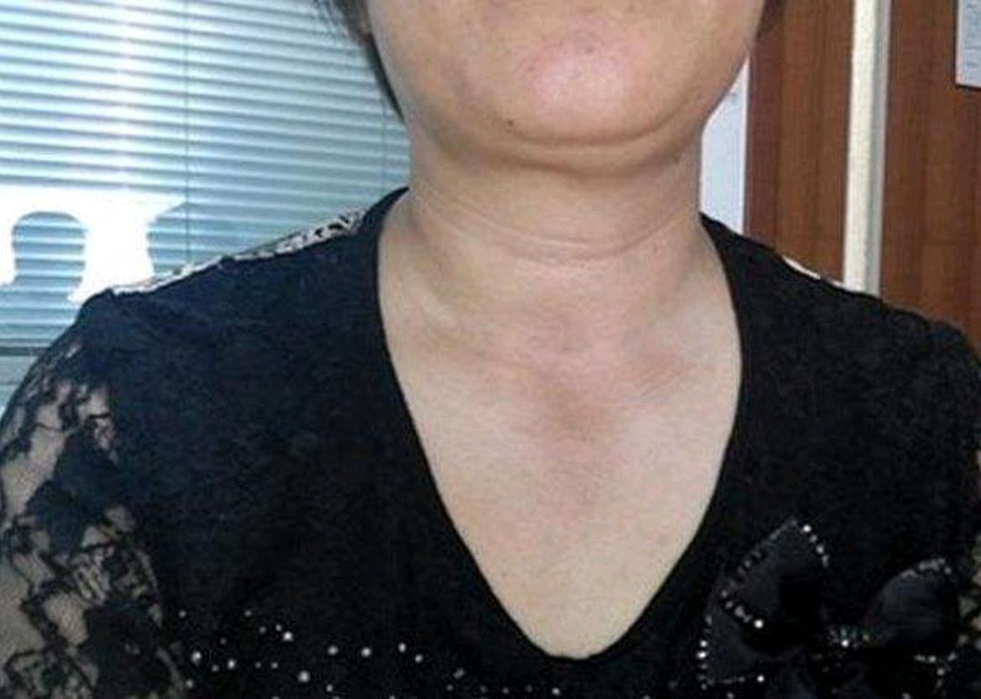 提醒甲状腺不好的人少碰1蛋2汤帮助保护甲状腺功能